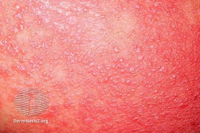rash-example